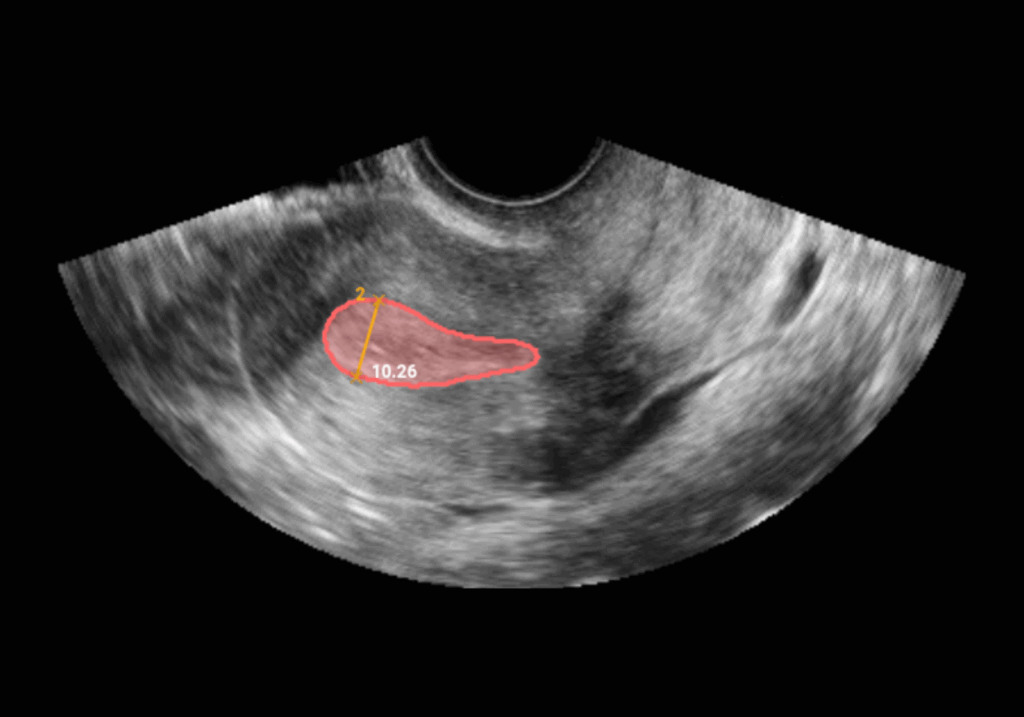 Ultrasound showing measured endometrial lining