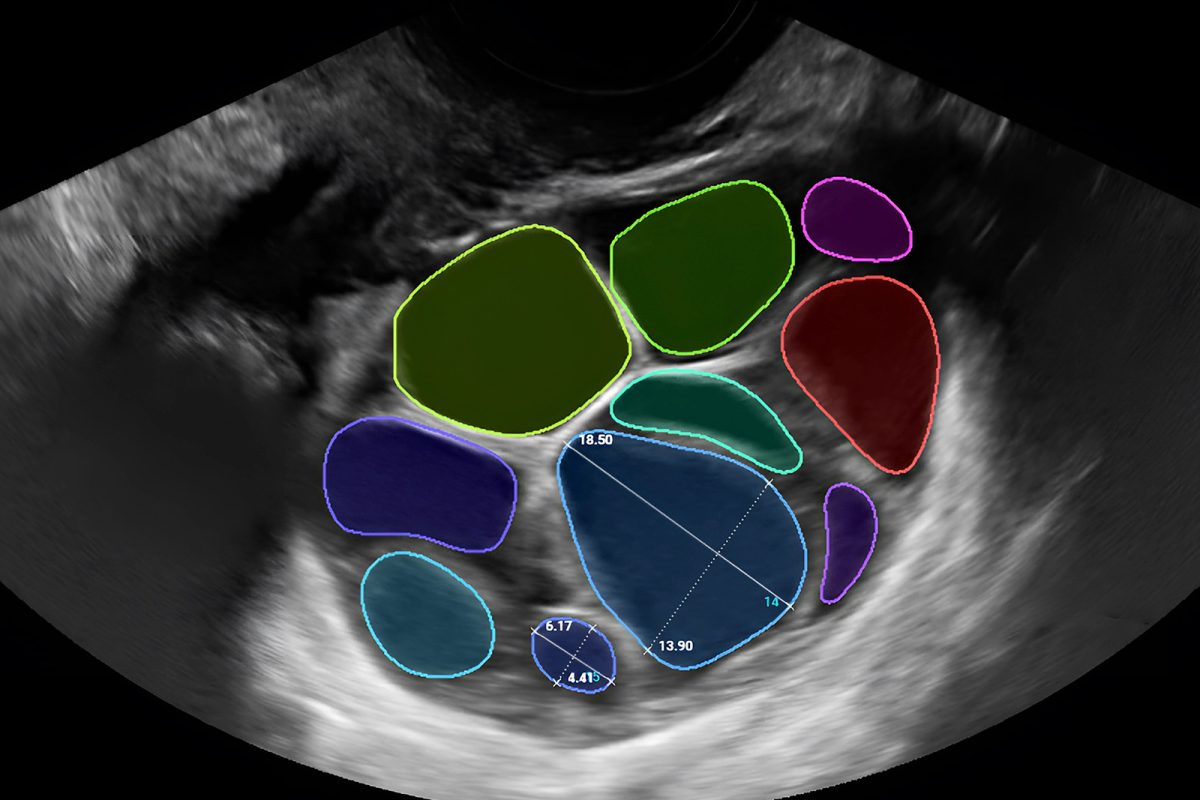 Annotated ultrasound showing ten detected ovarian follicles